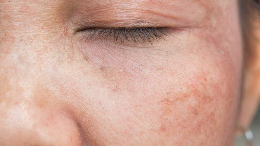 melasma tratamento