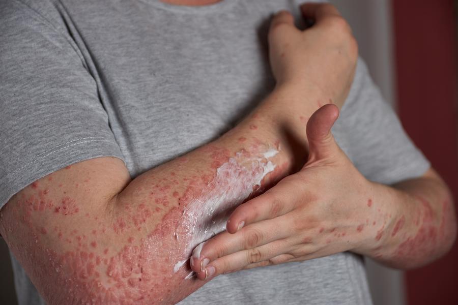 Pessoa passando pomada no braço em que está com dermatite atópica.