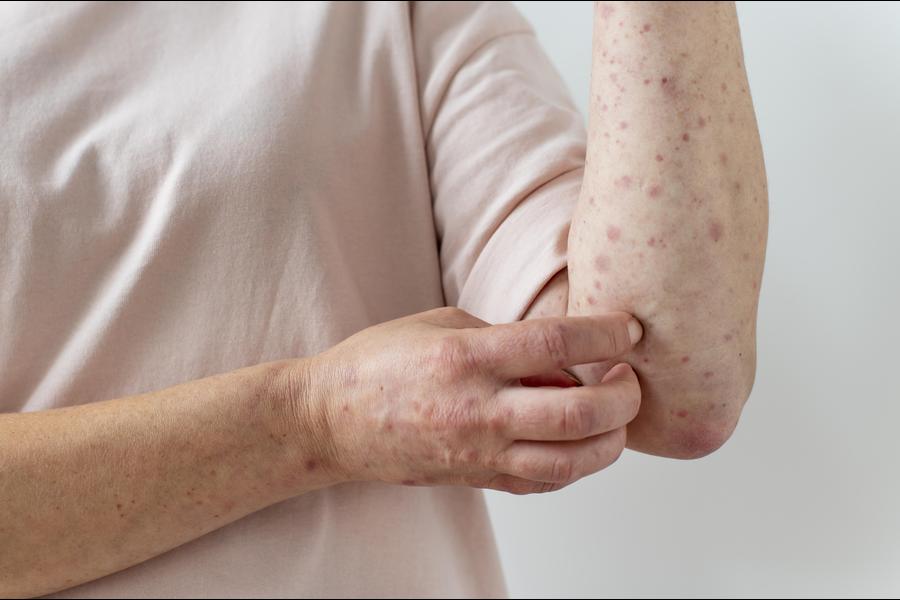 Dermatite atópica: saiba como ela se desenvolve e como pode ser tratada