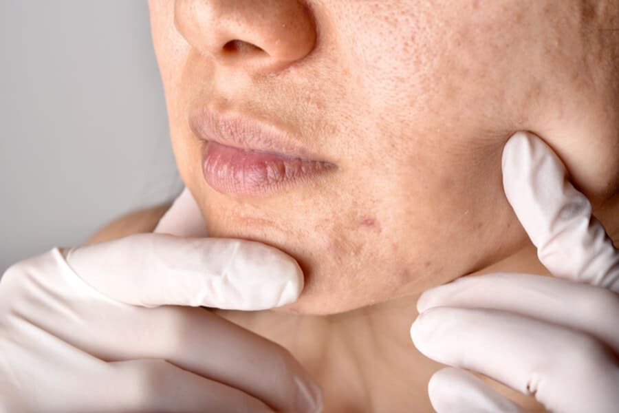 mapa da acne