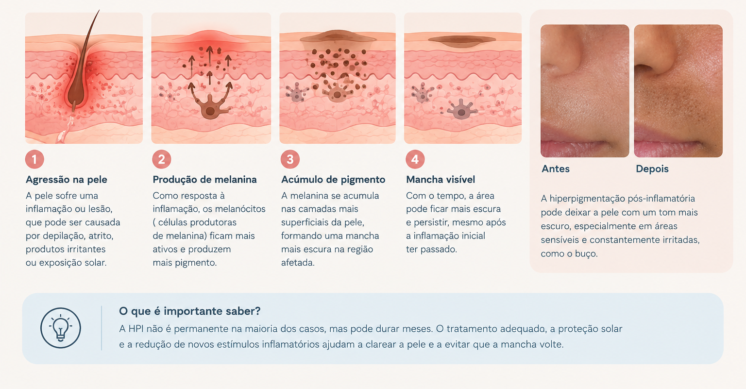 Mancha no buço: é possível removê-la? 1 Imagem explicativa com 4 passos de como se formam as hiperpigmentações, com antes e depois de pele.