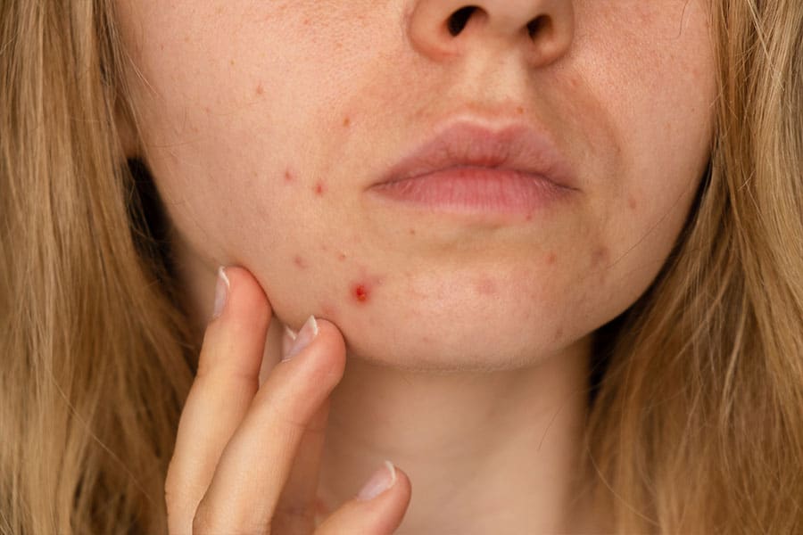 Manchas vermelhas na pele: confira as possíveis causas e tratamentos