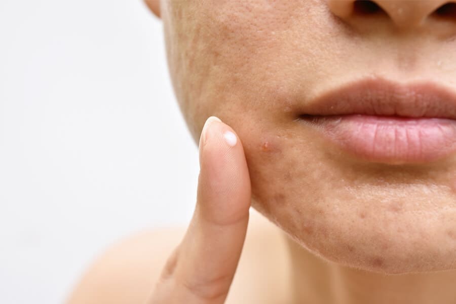 Conheça tipos de cicatriz de acne e como tratá-las