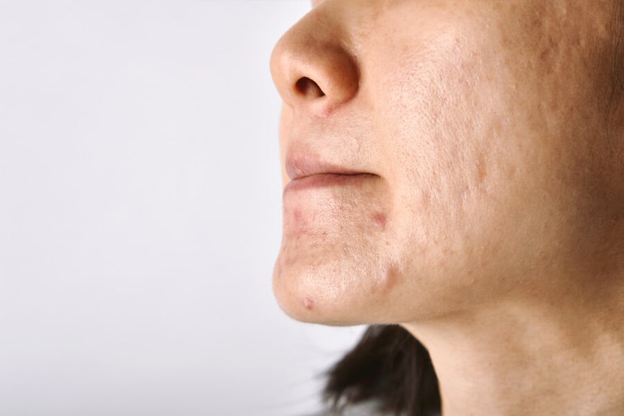cicatriz de acne