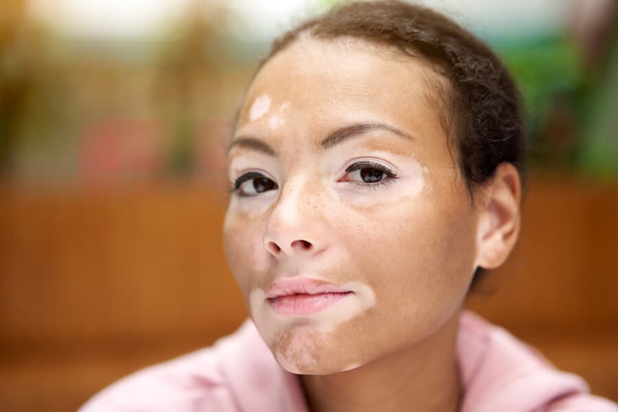 mulher com vitiligo na pele.