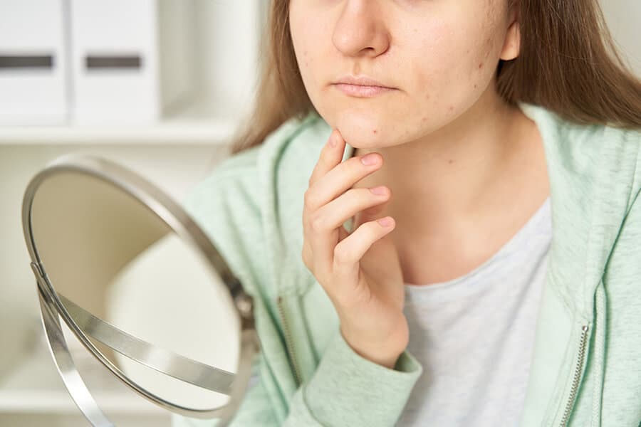mulher observando acne fúngica no rosto.