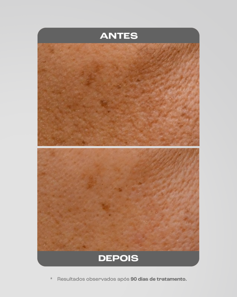 Ácido Tranexâmico para melasma: entenda os benefícios e como usar 2 Foto de pele com mancha de melasma antes e depois de usar ácido tranexâmico.