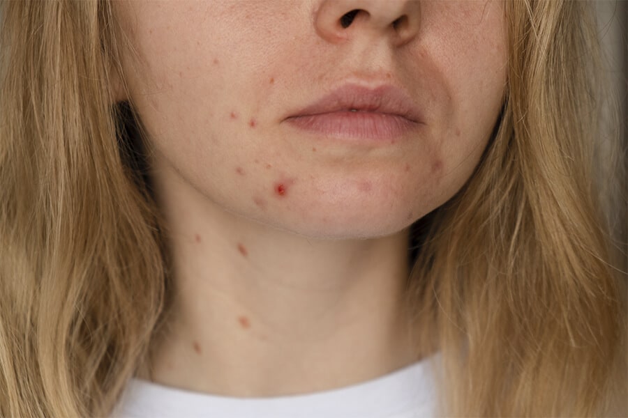 Mulher adulta com acnes.