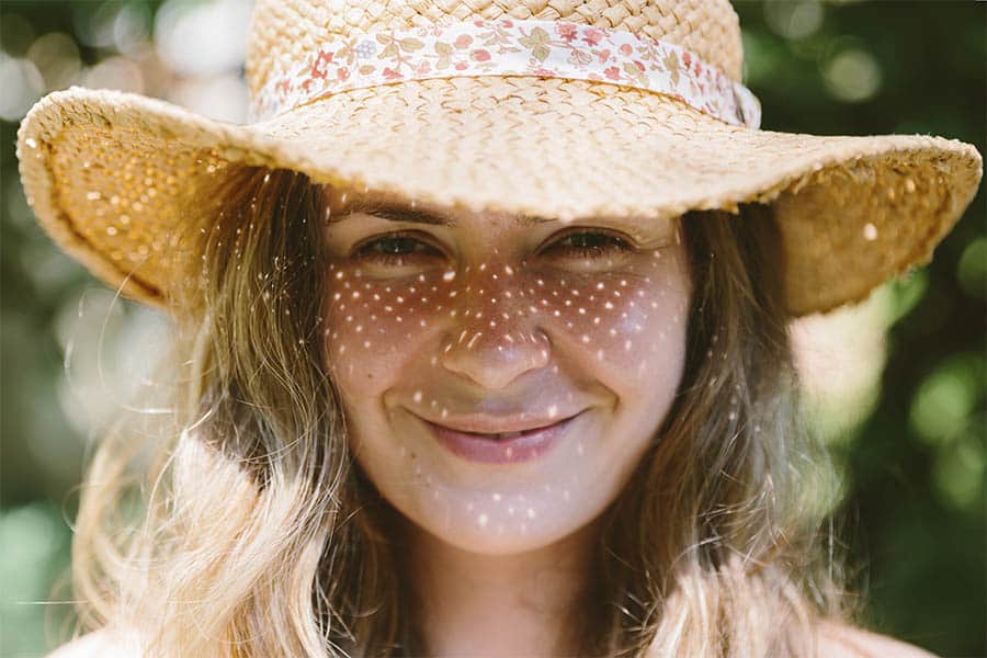 Melanose solar no rosto: o que é e como tratar?