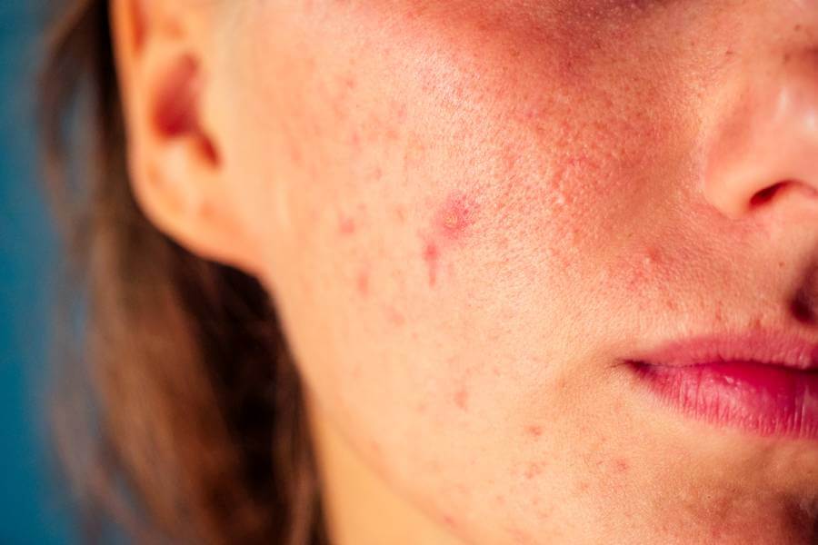 Como clarear a pele do rosto? Descubra 4 dicas