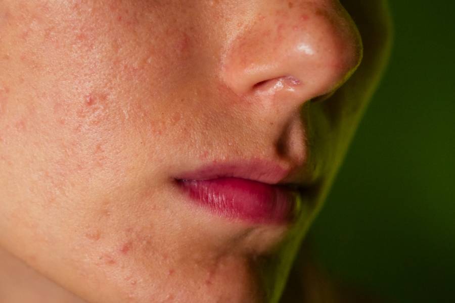 Manchas na pele: conheça as causas e as formas de tratamento