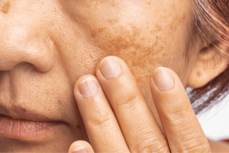 Menopausa causa manchas na pele? Confira como preveni-las e tratá-las