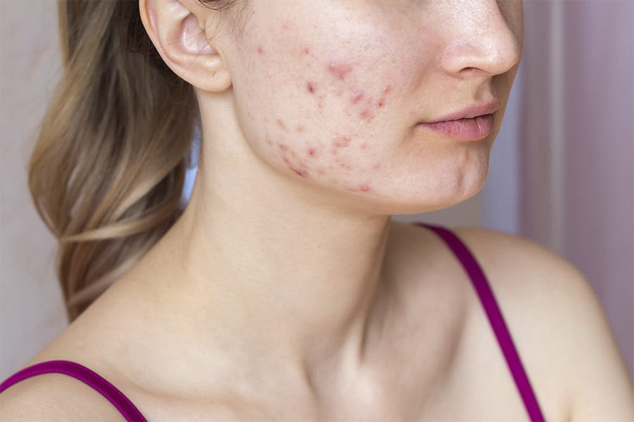 Descubra como melhorar manchas de acne sem agredir a pele