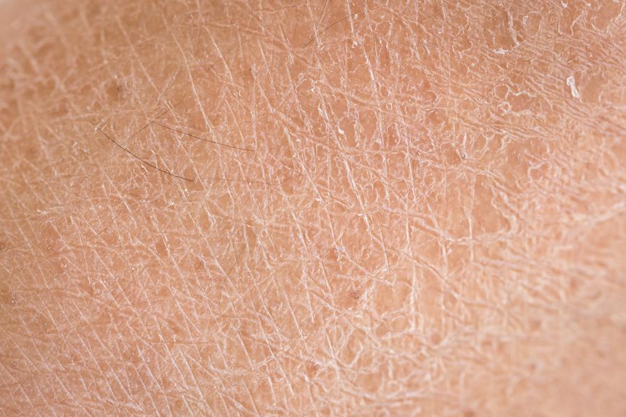 Pele do corpo seca e descamando: o que pode ocasionar isso?