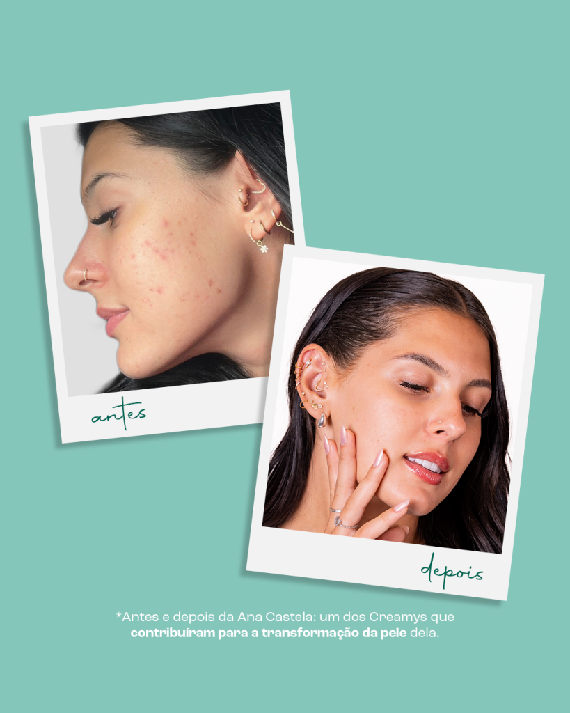 Descubra o que é espinha interna e como tratá-la 3 Antes e depois da Ana Castela usando Acne Defense 5D.