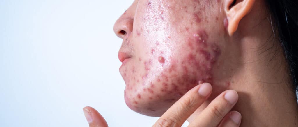 Desvendando a acne grau 5: quando a pele precisa de ajuda extra